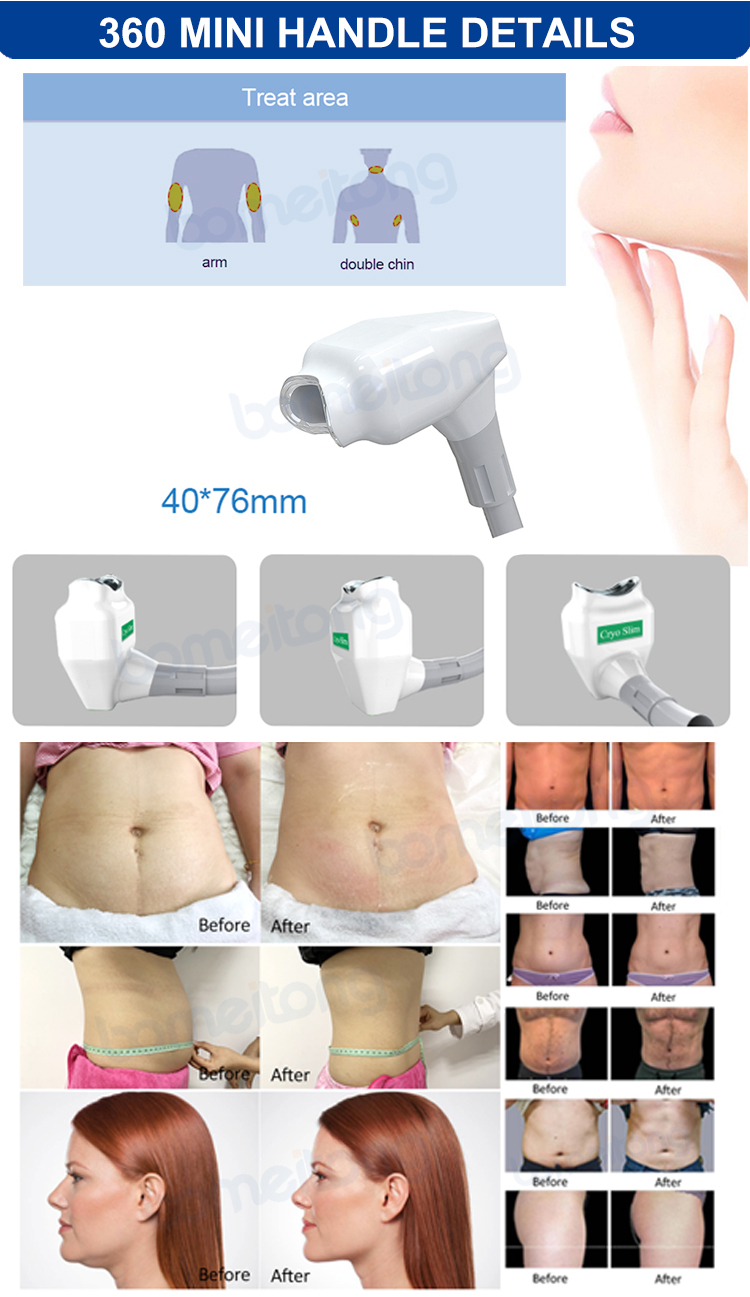 Cryolipolysis slim machine fat freeze double chin removal 360 cryo for sale Cryolipolysis slim machine fat freeze double chin removal 360 cryo for sale