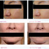 Emfacings Pe-face Pulselift Face Lifting Beauty Machine Wrinkle Removal Facial Tightening Machine