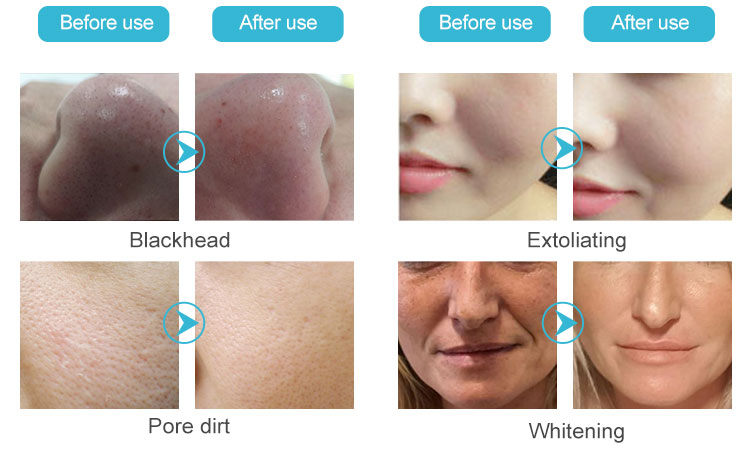 9 in 1 Space Water Oxygen Hydro Dermabrasion Facial Machine with Oxygen LED Mask11