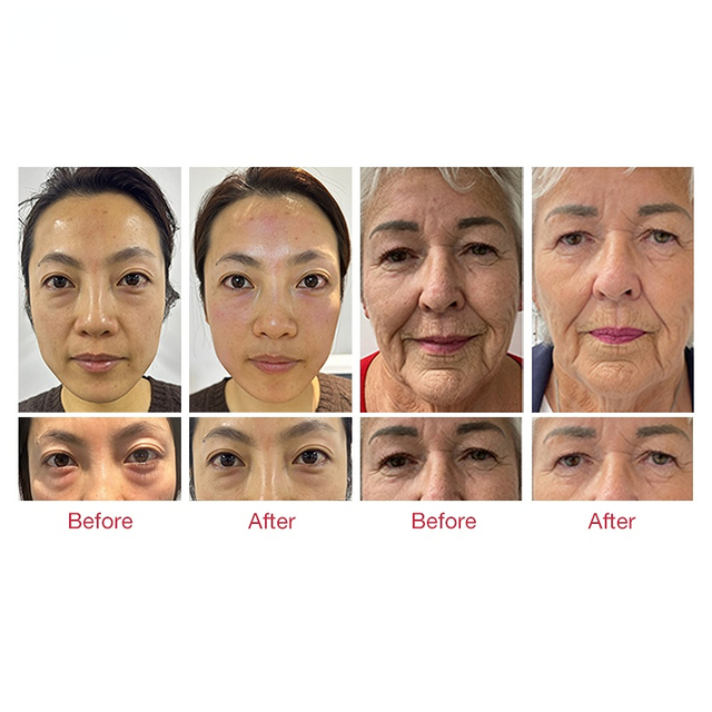 New Technology HILFES Beauty Face PCRF RF EMS Beauty Machine