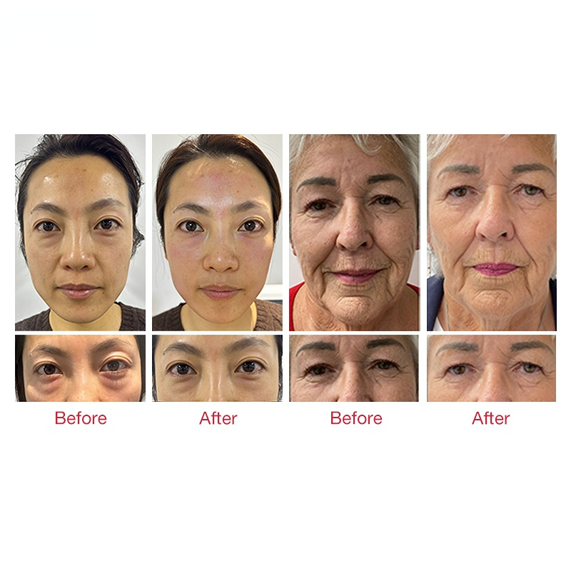 Skin Tightening Treatments Skin Firming Rejuvenation EMS RF Radio Frequency Face