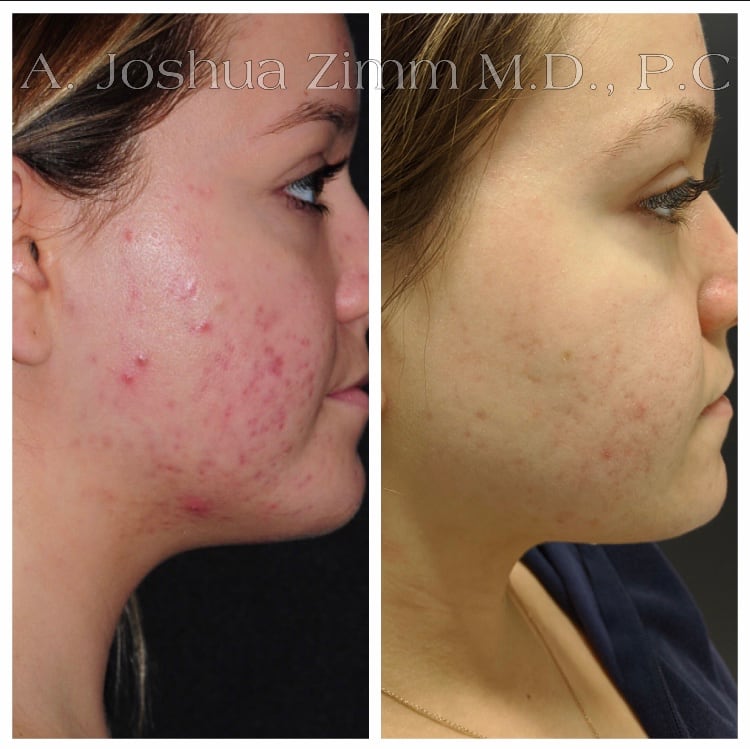 morpheus8-before-after2