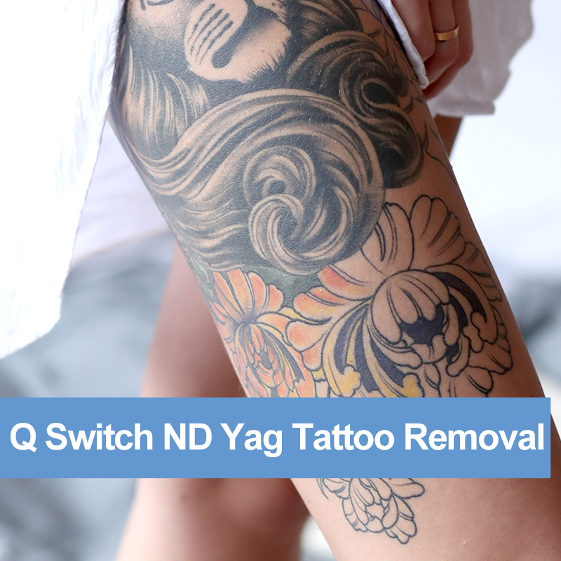 Laser Tattoo Removal