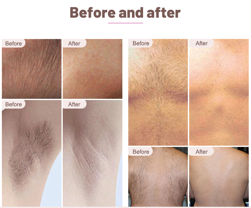 diode laser hair removal machinediode