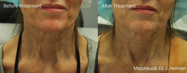 morpheus8-before-after