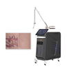 Nd Yag Q Switched Laser Tattoo Removal