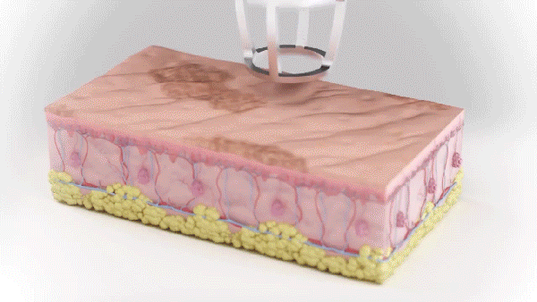 fractional co2 laser machine price