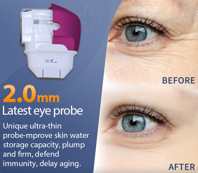 Cartuchos de máquina hifu de 2,0 mm