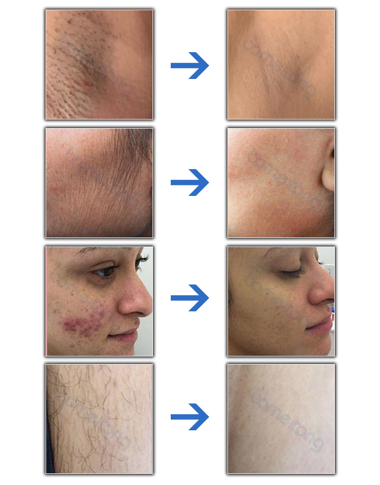 Best professional ipl laser hair removal machine SHR OPT DPL elight laser multifunctional double handle