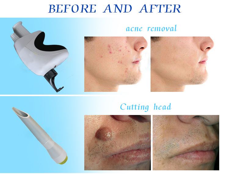 acne scars co2 fractional laser
