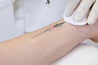//ikrorwxhqkrili5q.ldycdn.com/cloud/liBplKiolmSRjlnqijjliq/tattoo-removal.png