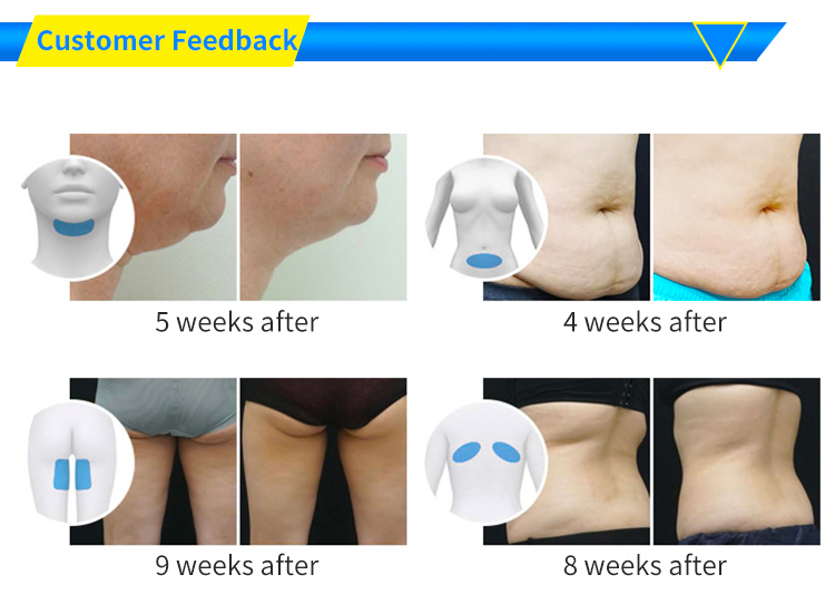 ultrasound cavitation home device