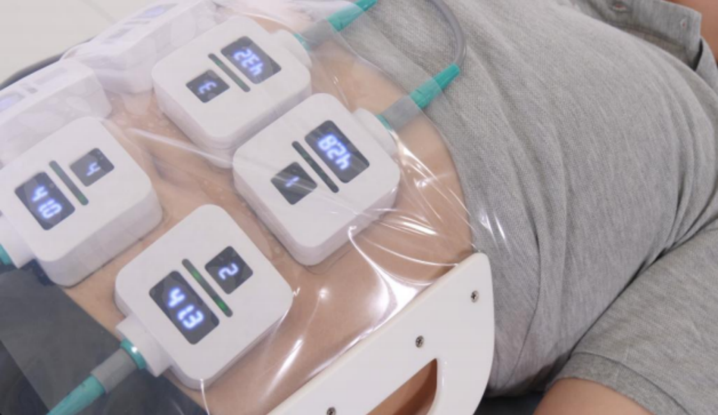 trusculpt id treatment