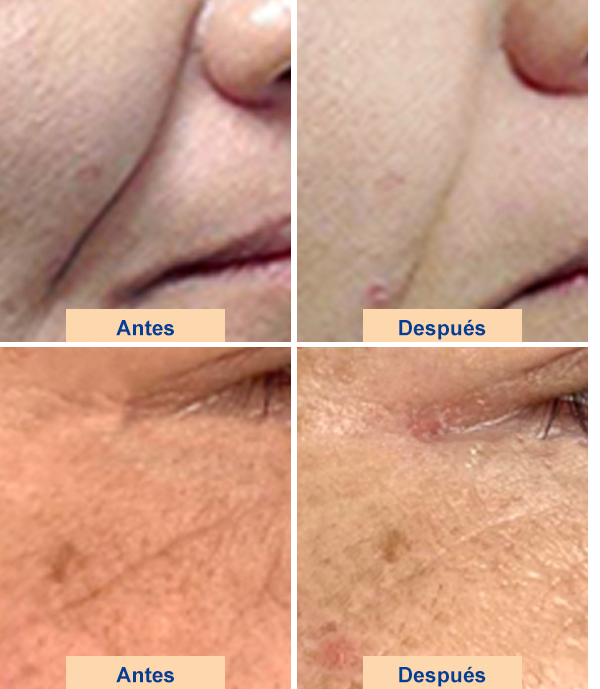 Matiné de piel de Ulte et al.