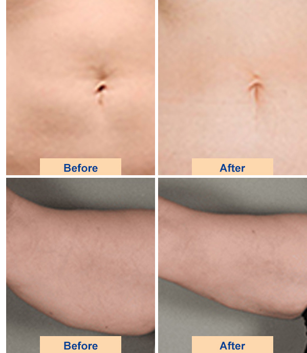 hifu face lifting machine