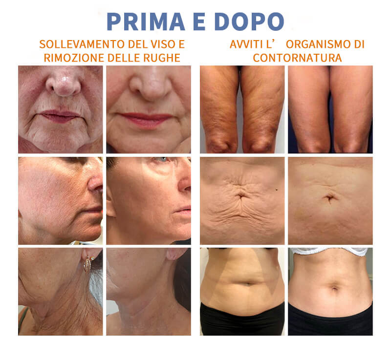 effetto macchina hifu