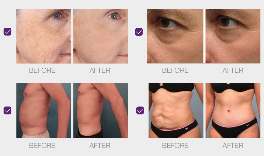 hifu vaginal tightening machine