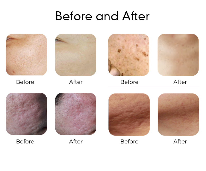 Fractional CO2 laser