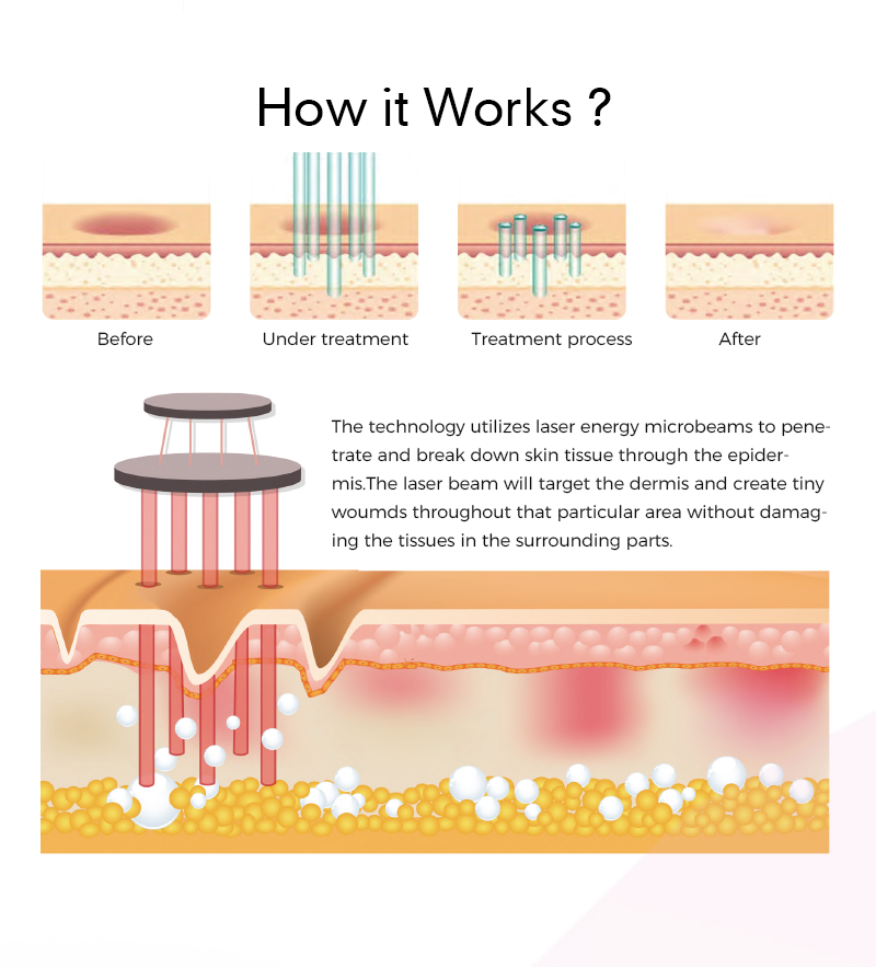 Fractional CO2 Laser