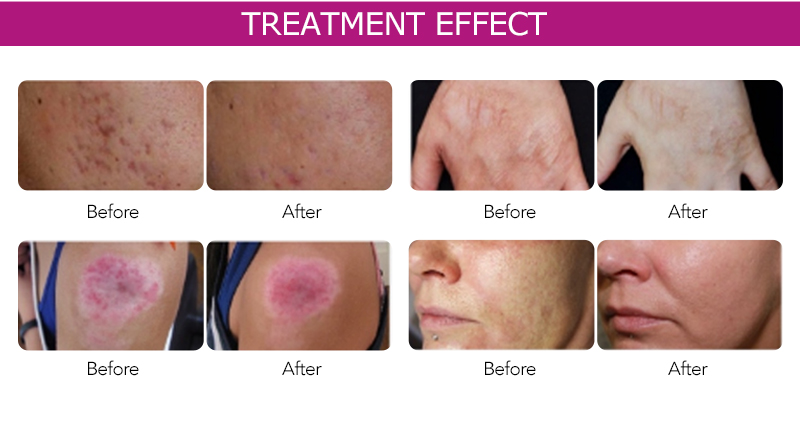 Buy Professional Fractional RF Microneedle Machine