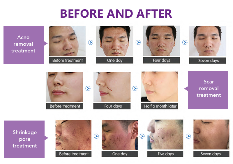 Fractional CO2 Laser Machine