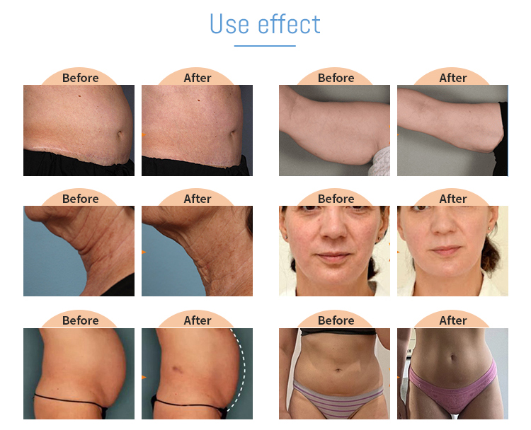 fda approved hifu machine