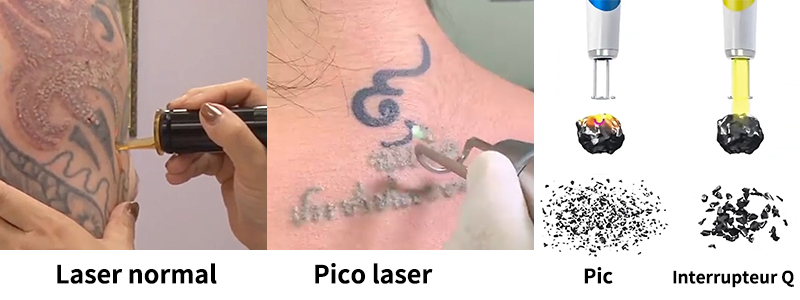 pico laser tattoo removal