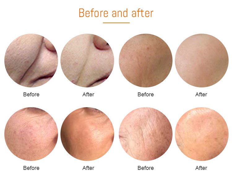 photochemical therapy