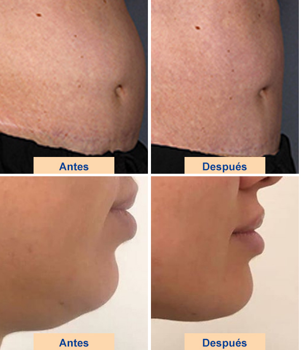 hifu face lifting machine