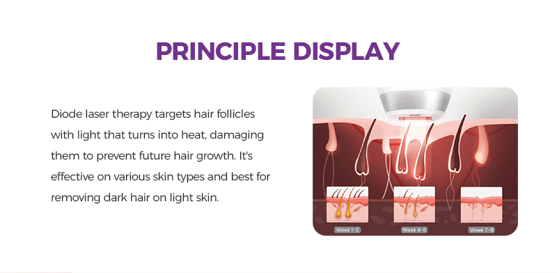 ice laser hair removal