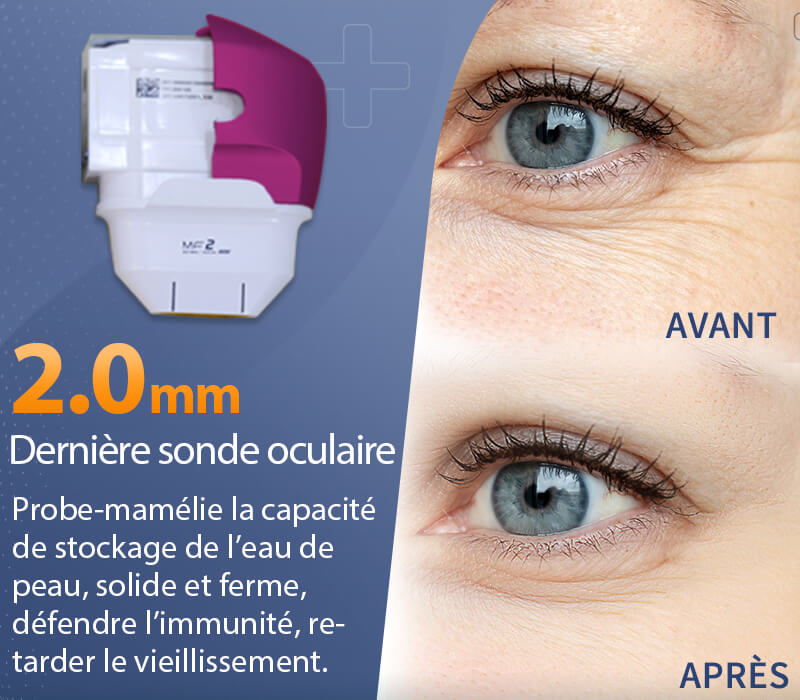 Cartouches de machine hifu de 2,0 mm