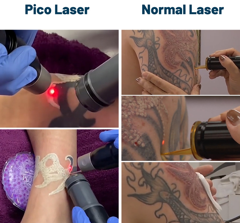 pico laser
