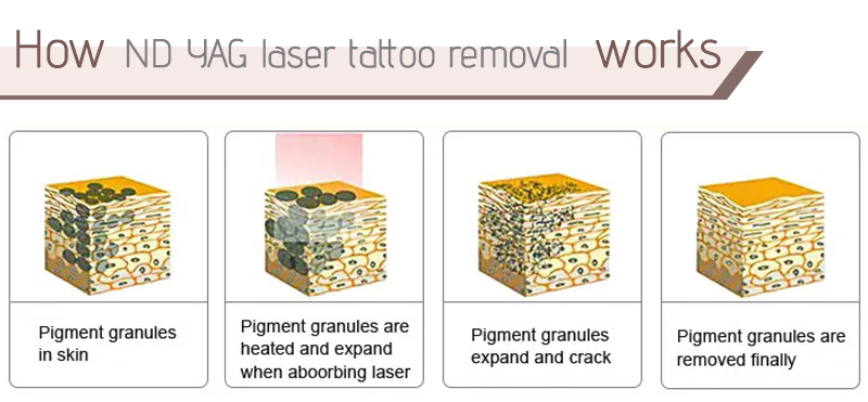 tattoo removal laser for sale