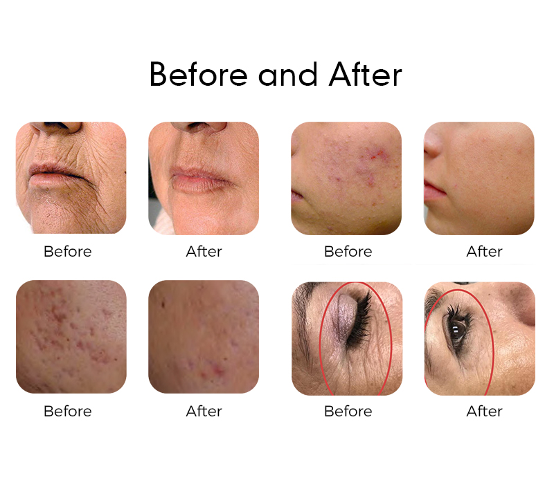 Erbium Lasers 1550nm Offer Effective Skin Resurfacing Solutions