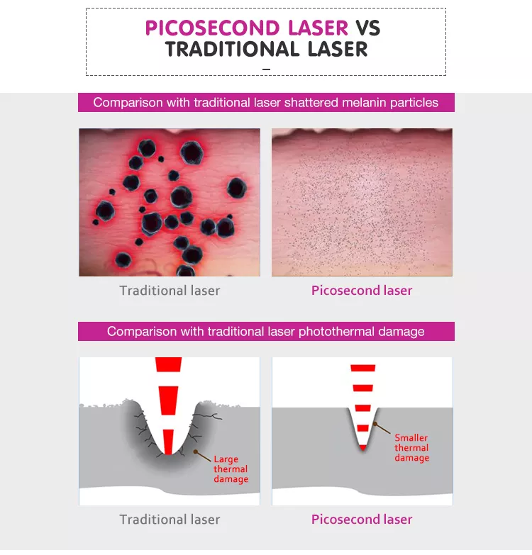 permanent tattoo removal