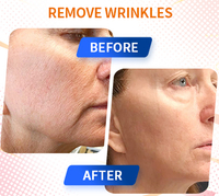 Anti ageingv hifu machine