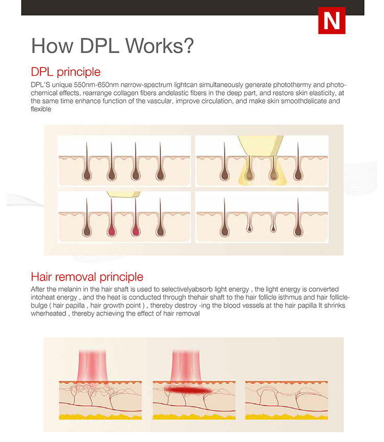 the best ipl hair removal