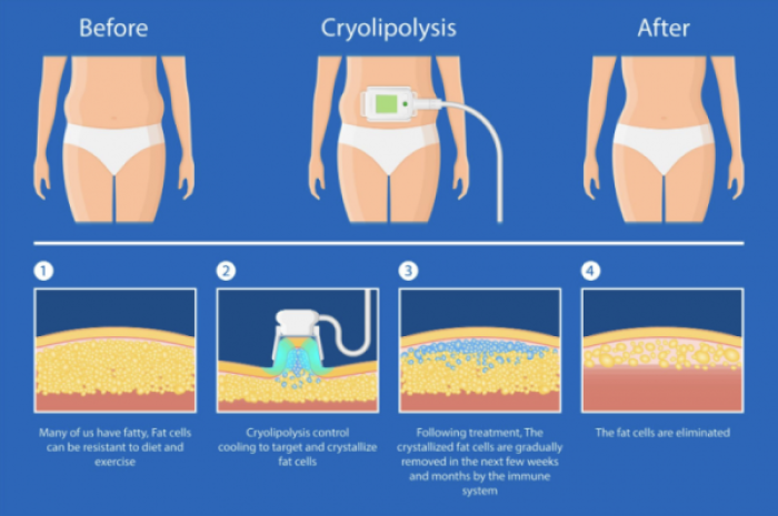 cryolipolysis treatment