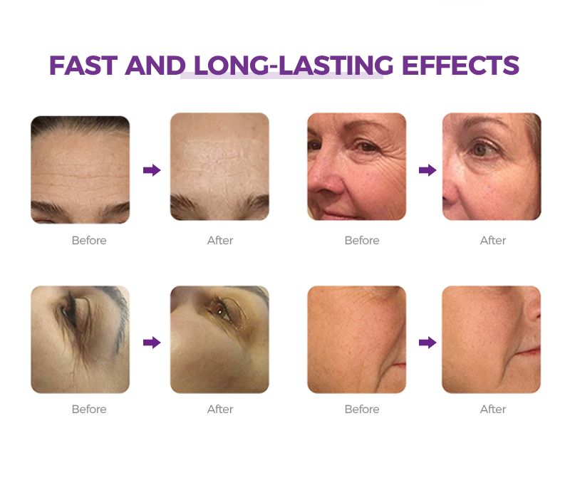 Silk Wave Lifts Tightens Skin