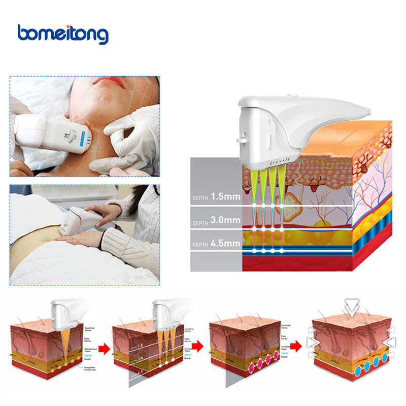 Skin Tightening Body Slimming 3D Lifting Portable Hifu High Intensity Focused Ultrasound for Salon 