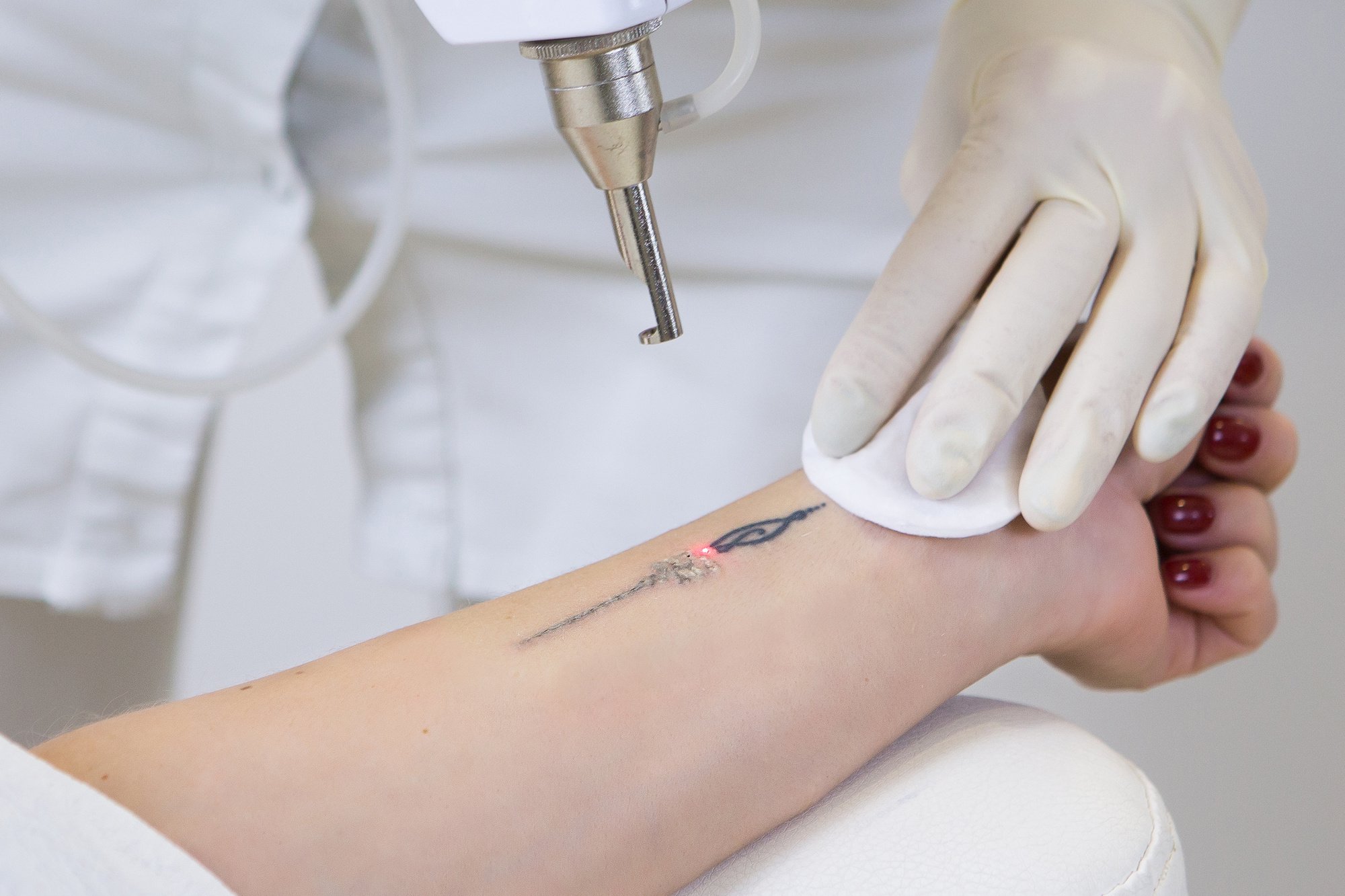 Everything to Know About The Pico Laser Treatment