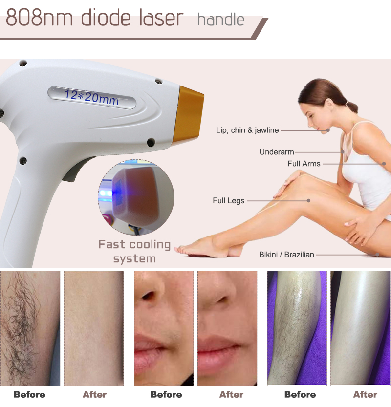 laser hair removal buy