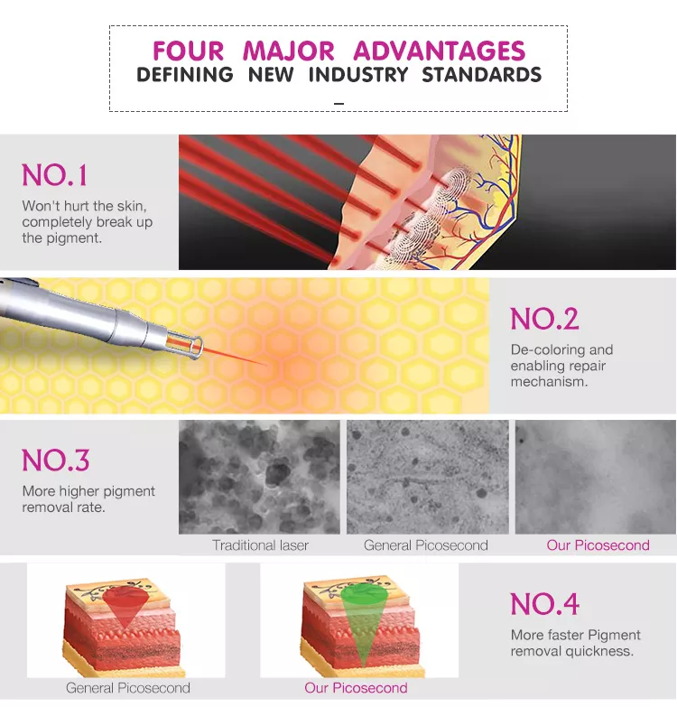 effective tattoo removal