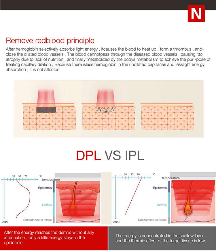 personal laser hair removal