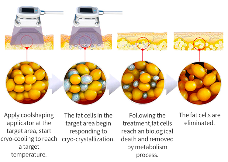 cryolipolysis weight loss machine