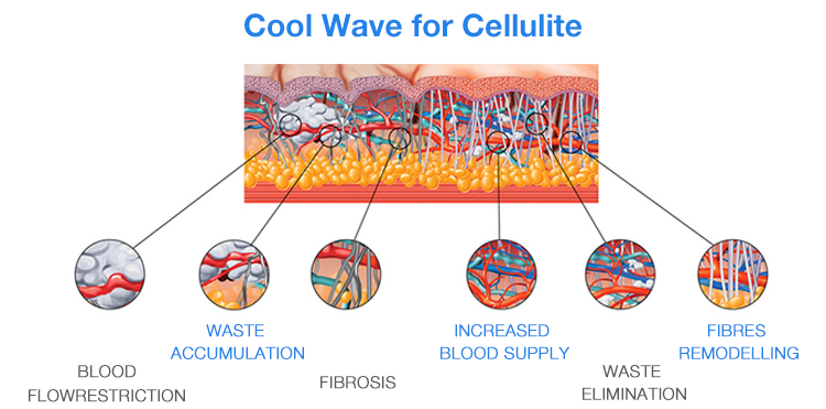 shockwave therapy machine