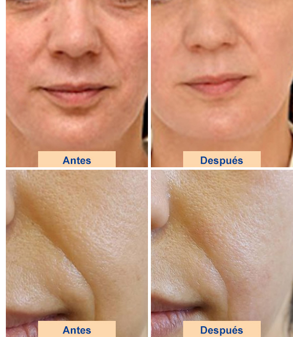 máquina de estiramiento facial hifu