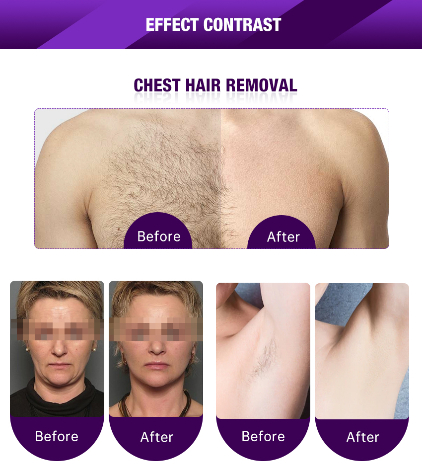 back hair removal for men