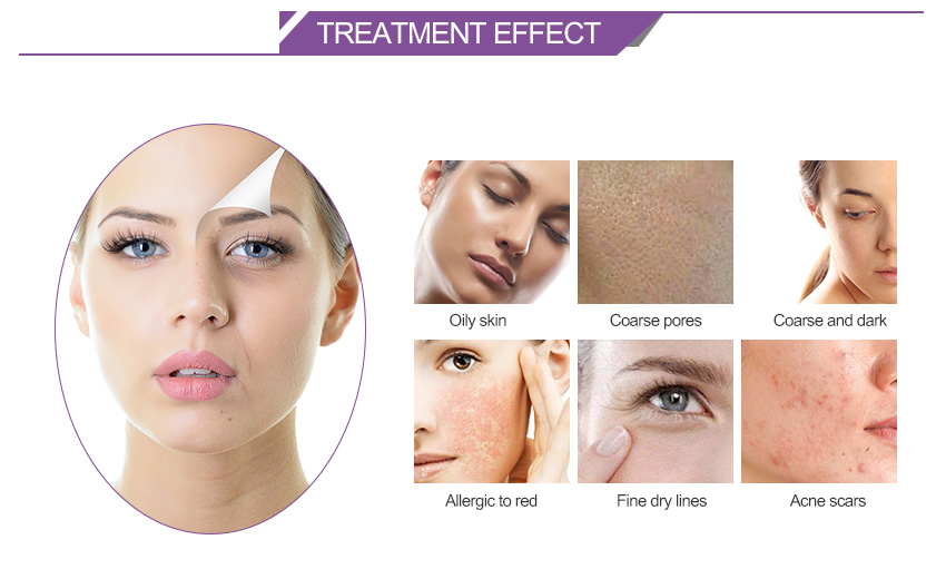 oxygen facial machine