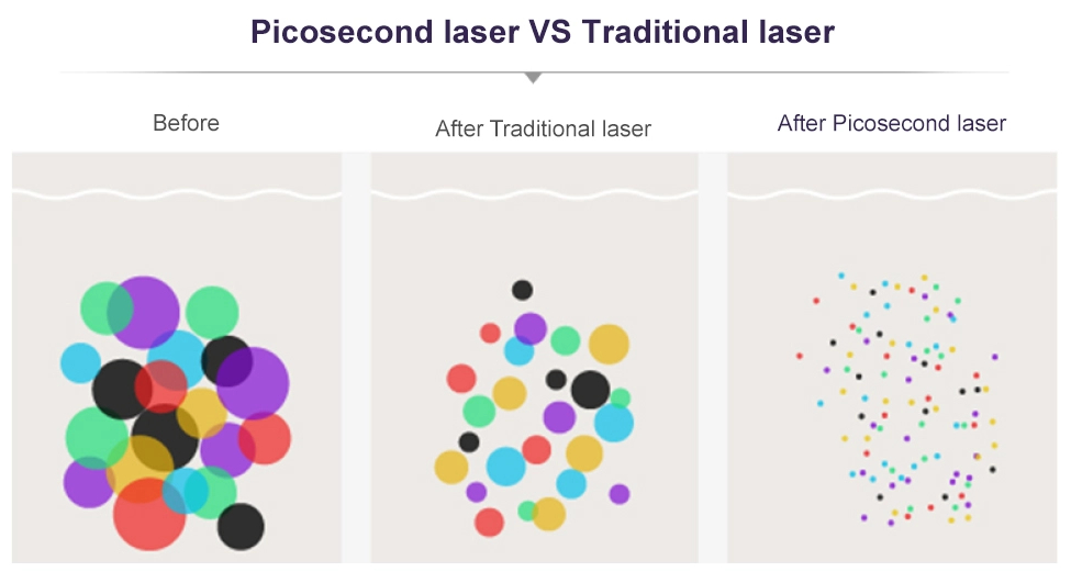 tattoo removal machine